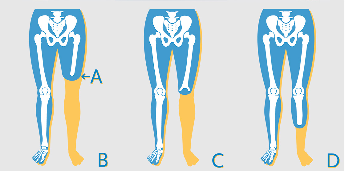 Ossur_Levels_of_Amputation_1